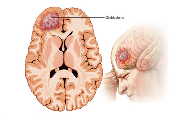 الیگودندروگلیوما