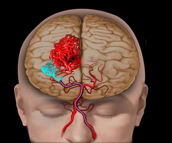 2-لخته-خون-در-مغز