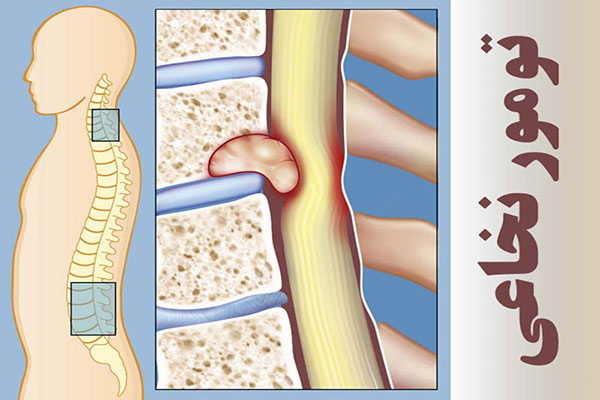 جراح-تومور-نخاعی-در-تهران