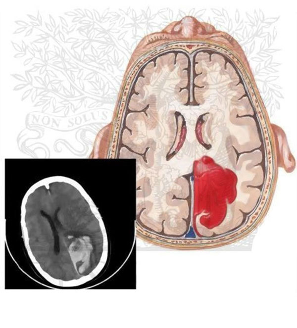 لخته-خون-در-مغز3