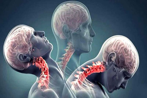 علایم-آرتروز-گردن