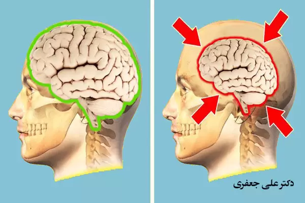 کوچک-شدن-مغز