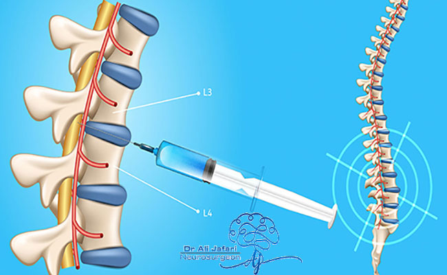  سوالات متداول جراحی دیسک کمر از دکتر علی جعفری 